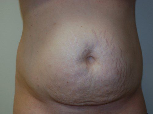 Tummy Tuck Before Patient 1