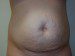 Tummy Tuck Before Patient Thumbnail 1