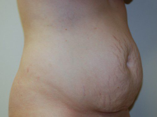 Tummy Tuck Before Patient 2