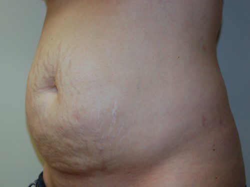 Tummy Tuck Before Patient 3