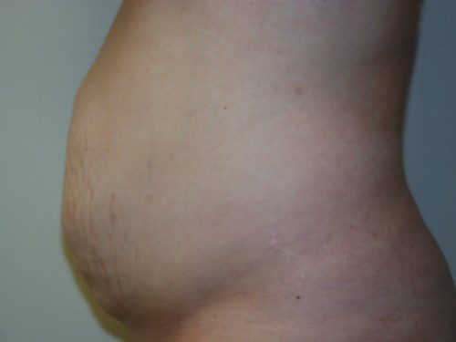 Tummy Tuck Before Patient 5