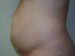 Tummy Tuck Before Patient Thumbnail 5