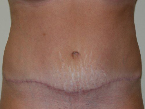 Tummy Tuck After Patient 1