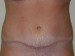 Tummy Tuck After Patient Thumbnail 1