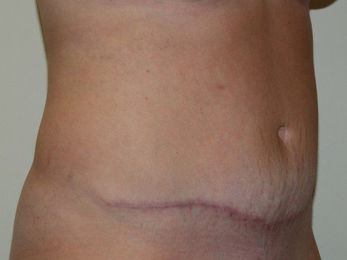 Tummy Tuck After Patient 2