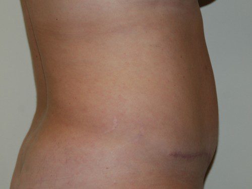 Tummy Tuck After Patient 4