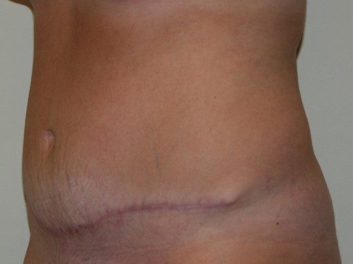 Tummy Tuck After Patient 3