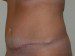 Tummy Tuck After Patient Thumbnail 3