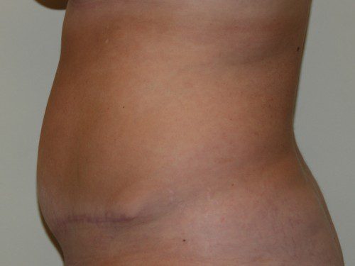 Tummy Tuck After Patient 5