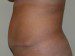 Tummy Tuck After Patient Thumbnail 5