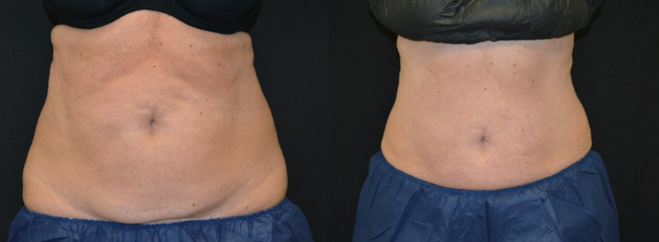Option for the post pregnancy tummy pooch?… #tummytuck