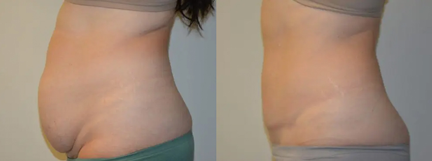 tummy tuck before and after side view