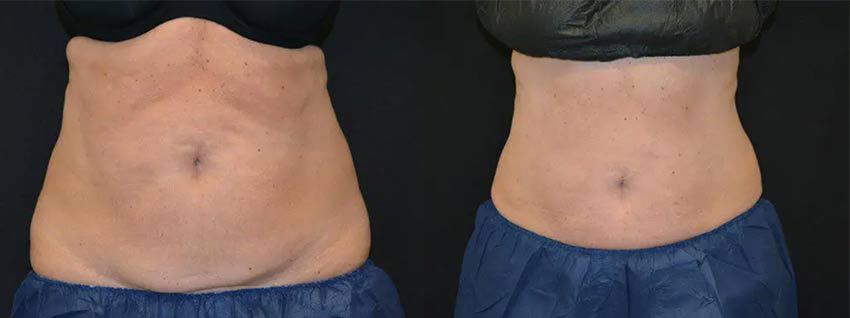 CoolSculpting® before and after photo