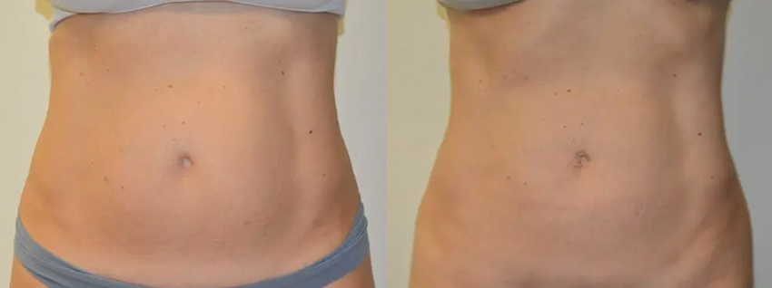 Liposuction before and after photo