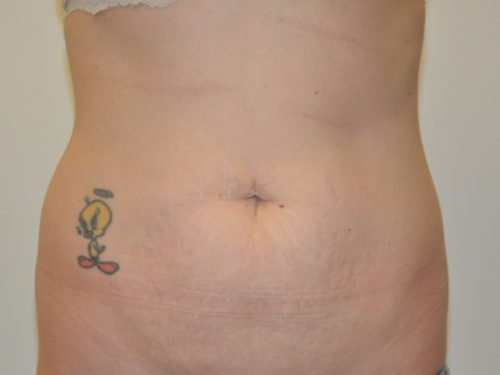 Tummy Tuck Before Patient 1