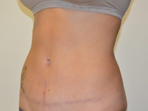 Tummy Tuck After Patient 2