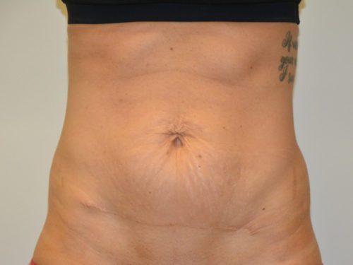 Tummy Tuck Before Patient 1