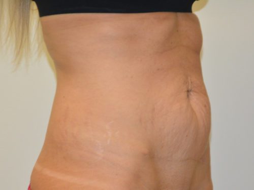 Tummy Tuck Before Patient 2