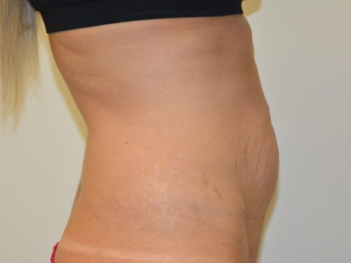 Tummy Tuck Before Patient 3