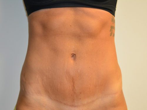 Tummy Tuck After Patient 1