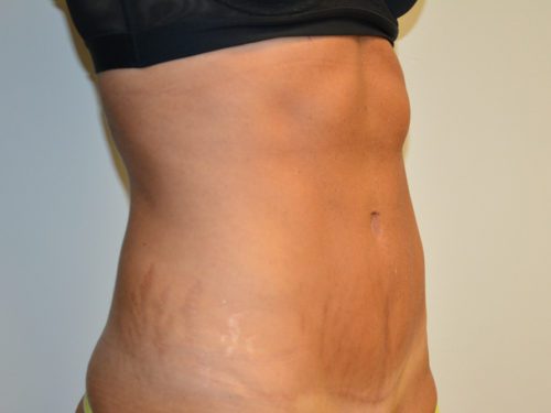 Tummy Tuck After Patient 2