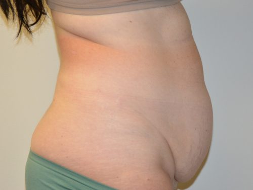 Tummy Tuck Before Patient 4