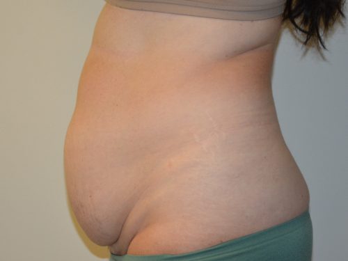 Tummy Tuck Before Patient 3