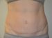 Tummy Tuck After Patient Thumbnail 1