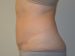 Tummy Tuck After Patient Thumbnail 3