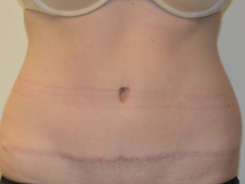 Tummy Tuck After Patient 1