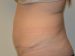 Tummy Tuck After Patient Thumbnail 3