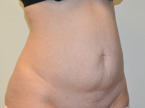 Tummy Tuck Before Patient 2