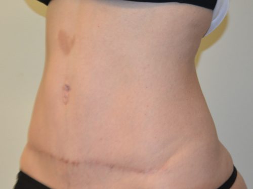 Tummy Tuck After Patient 4