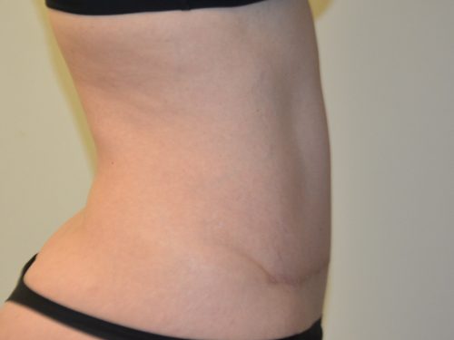 Tummy Tuck After Patient 3