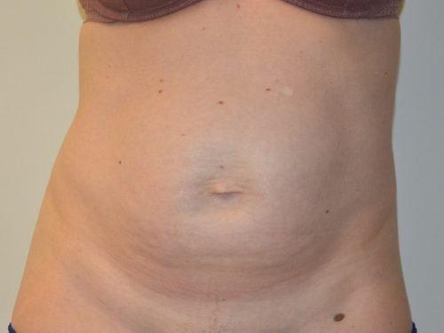 Tummy Tuck Before Patient 1