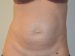 Tummy Tuck Before Patient Thumbnail 1