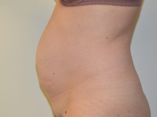 Tummy Tuck Before Patient 3