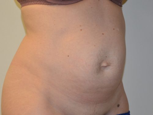 Tummy Tuck Before Patient 4