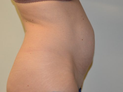 Tummy Tuck Before Patient 5