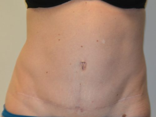 Tummy Tuck After Patient 1