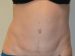 Tummy Tuck After Patient Thumbnail 1