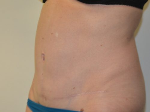 Tummy Tuck After Patient 2