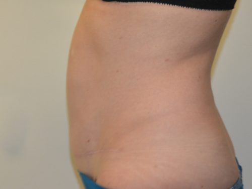 Tummy Tuck After Patient 3