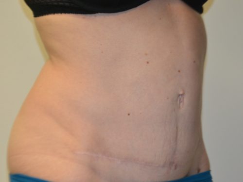 Tummy Tuck After Patient 4