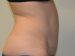 Tummy Tuck After Patient Thumbnail 5