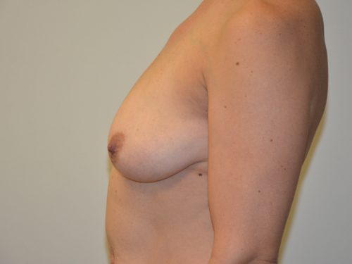 Breast Lift Before Patient 3