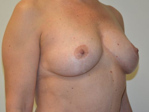 Breast Lift After Patient 4