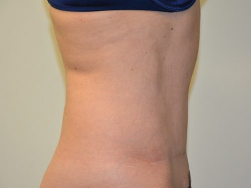 Tummy Tuck After Patient 5