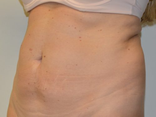 Tummy Tuck Before Patient 4