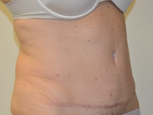 Tummy Tuck After Patient 2